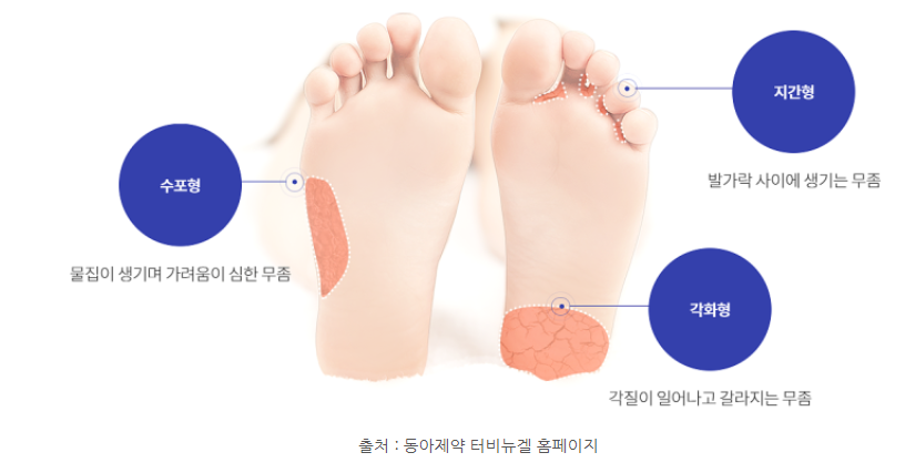  손톱, 발톱 무좀에 걸리기 쉬운 사람 / 무좀 없애는 방법 / 무좀약 추천