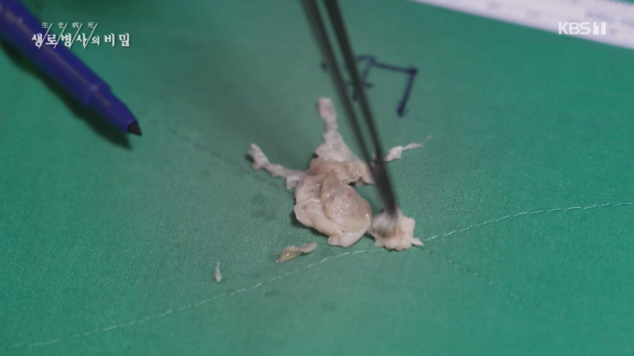 생로병사의 비밀.E900.240215p-NEXT.mp4_20240215_202856.848.jpg