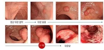 대장내시경 용종제거 후 식사 식단조절_28