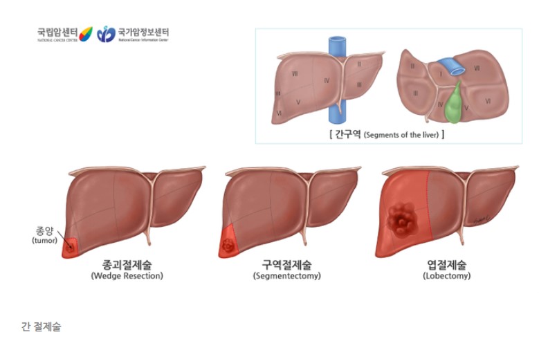 간절제술