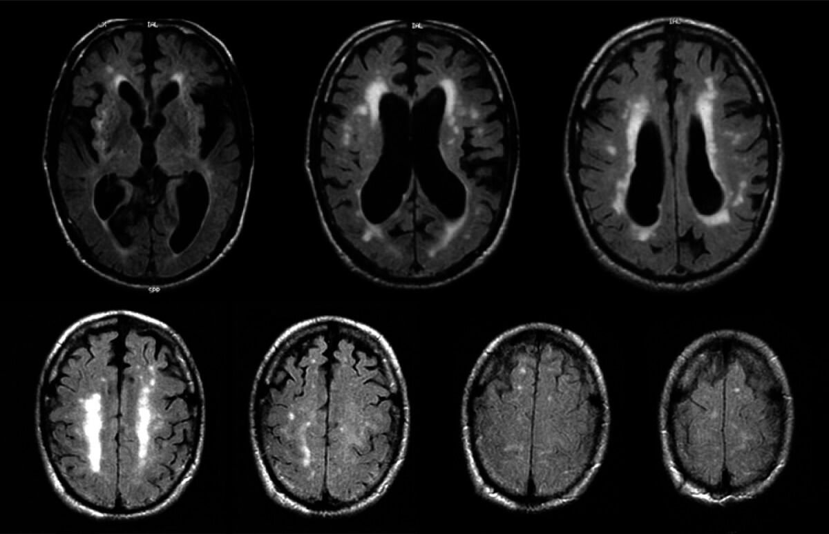 Vascular Parkinsonism 2