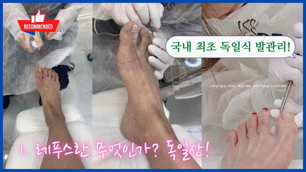 레푸스 가격 및 비용, 실제 후기 모음 (Feat. 레푸스 내성발톱 가격) 레푸스 가격 및 비용, 실제 후기 모음 (Feat. 레푸스 내성발톱 가격)