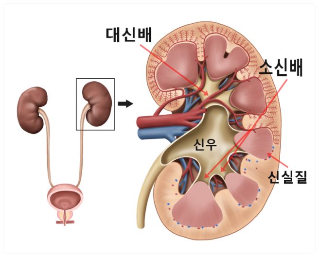 신우신염 증상