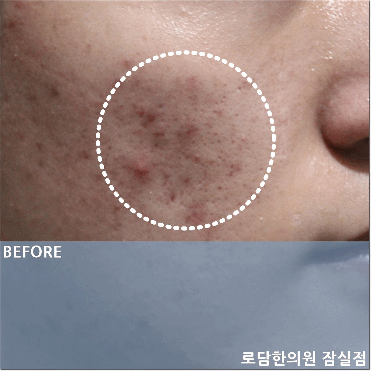  잠실여드름흉터 제거 새살침 코라테라피 시술 치료를 통해