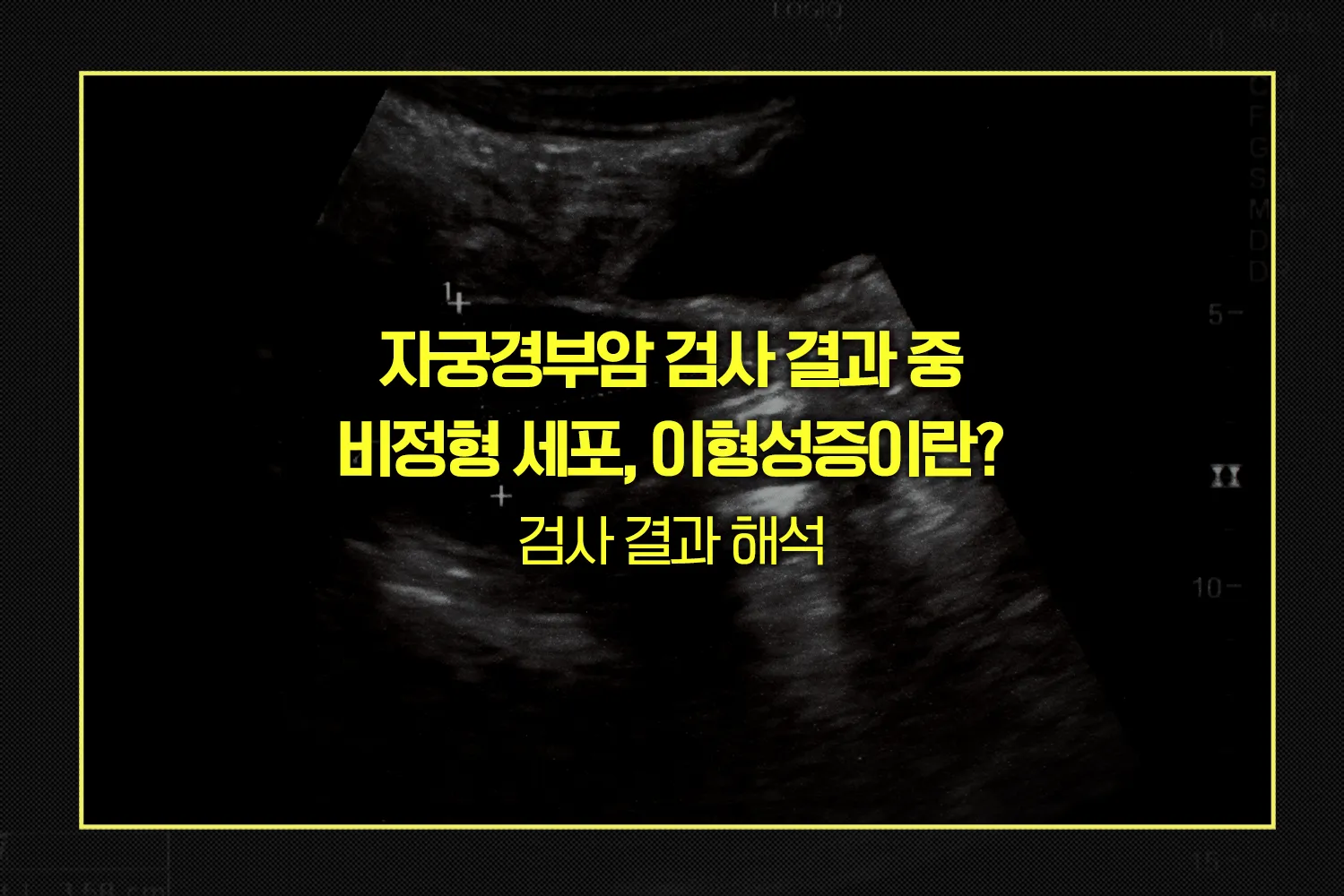 자궁경부암검사-비정형세포-이형성증-해석