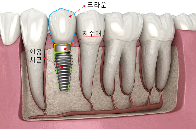 임플란트-구조