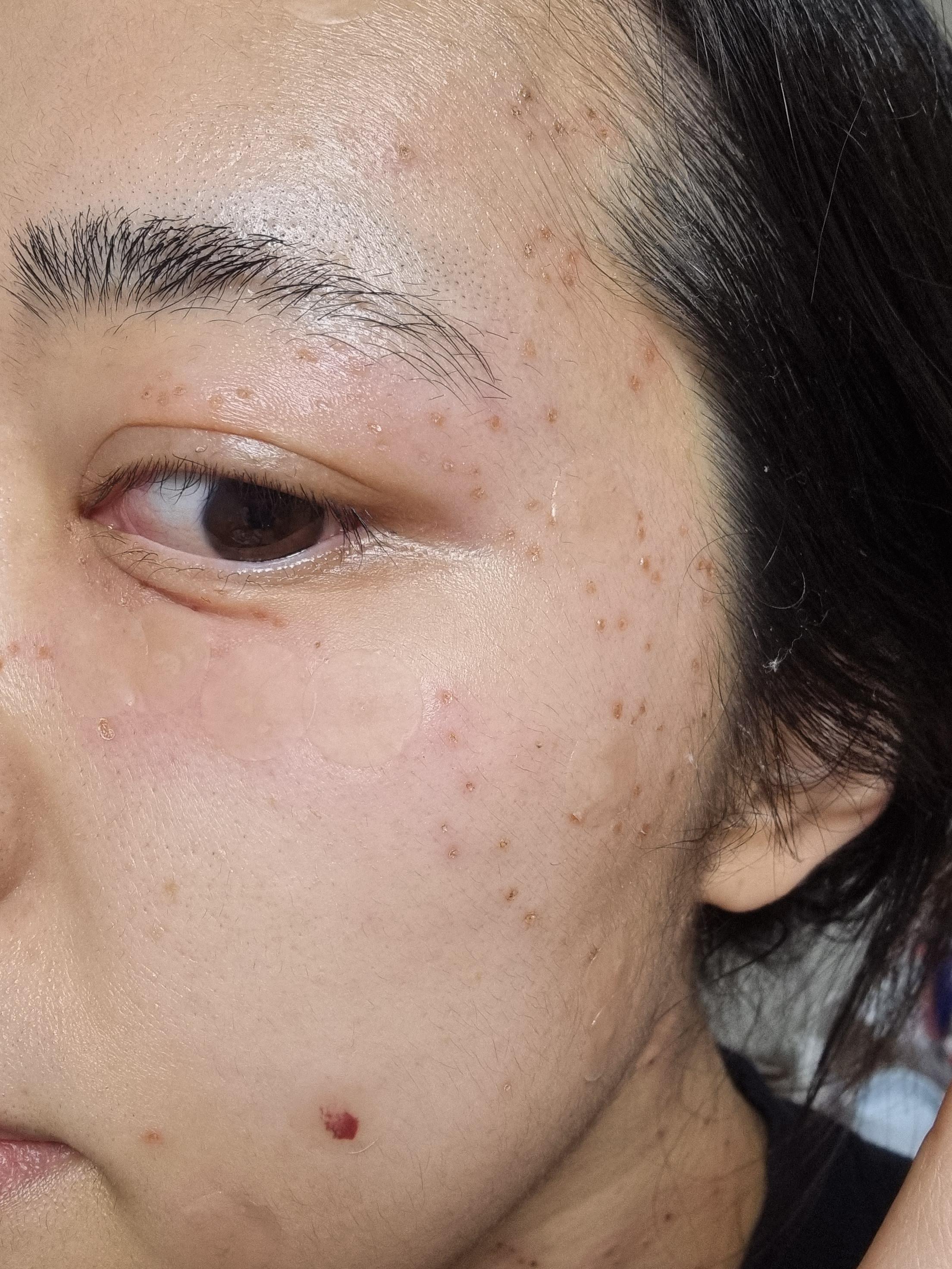  노원역 피부과 편평사마귀 얼굴+목 전체 제거 후기 (당일~2주차)