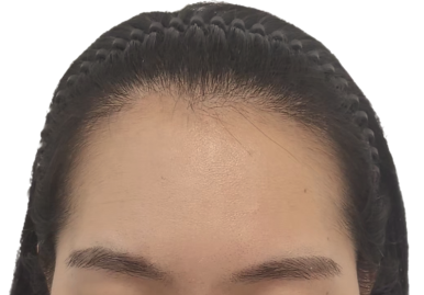 헤어라인 이미지