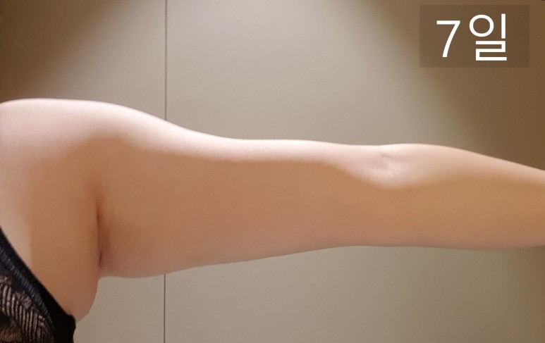 좋네요. 2회차 후기 지방분해주사 팔뚝살빼기 딱 15