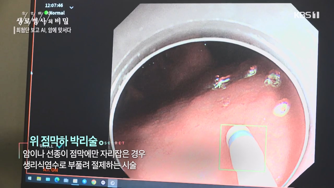 생로병사의 비밀.E881.230831p-NEXT.mp4_20230901_223248.545.jpg