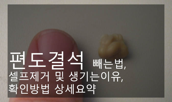 편도결석 빼는법, 셀프제거 및 생기는이유, 확인방법 상세요약