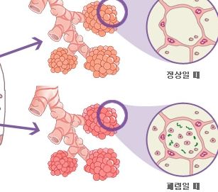 폐렴 증상