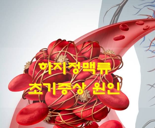  하지정맥류 초기증상 원인
