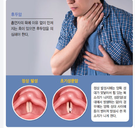 후두암의 원인과 치료 방법