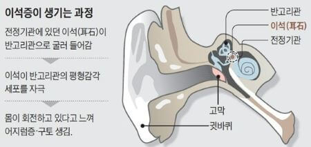 이석증