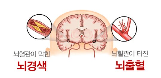 뇌혈관질환 종류