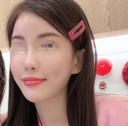  피부과 VVIP가 쓰는 쥬베룩볼륨 후기 (용량,붓기,부작용)