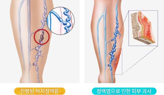 하지 정맥류 증상&amp;#44; 원인