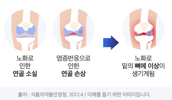 연골 손상 진행