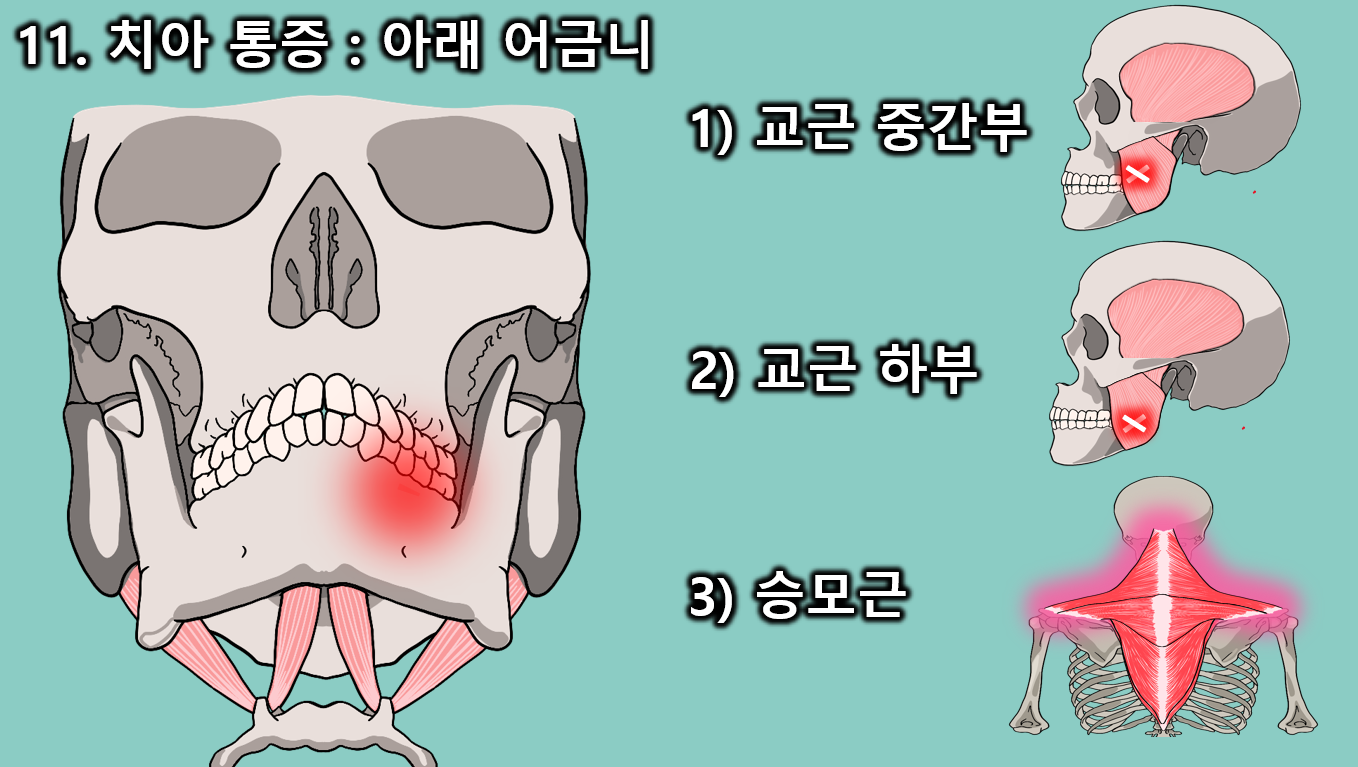 턱관절 근육통 통증유발점과 이비인후과 증상 총정리