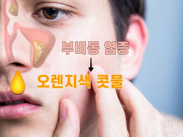 콧물 색깔별 증상,오렌지색 콧물 색깔로 보는 건강,부비동염