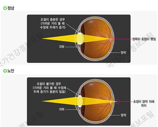 노안의원인