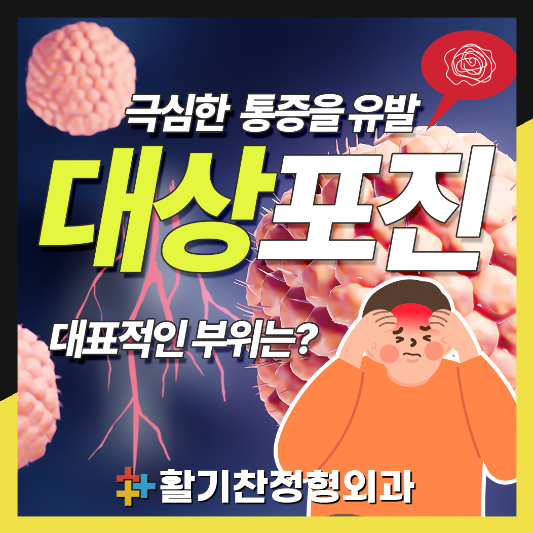  연신내 대상포진 발생부위 및 예방접종 시기