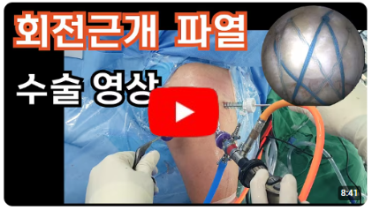 회전근개파열 수술 - 관절 내시경 회전근개 봉합수술 영상