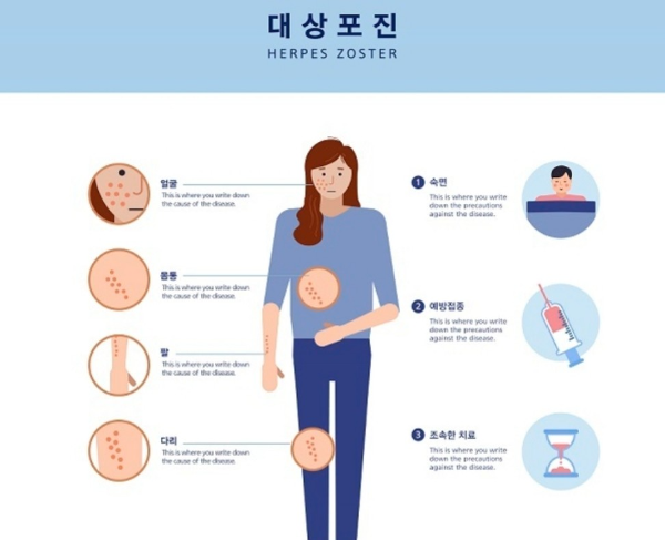 대상포진 원인 및 치료&#44;예방