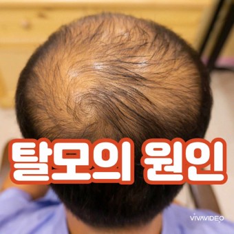  탈모 원인 예방