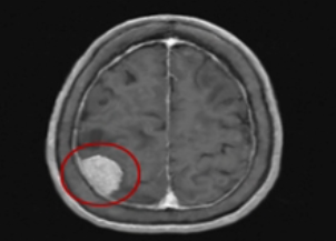 뇌종양
