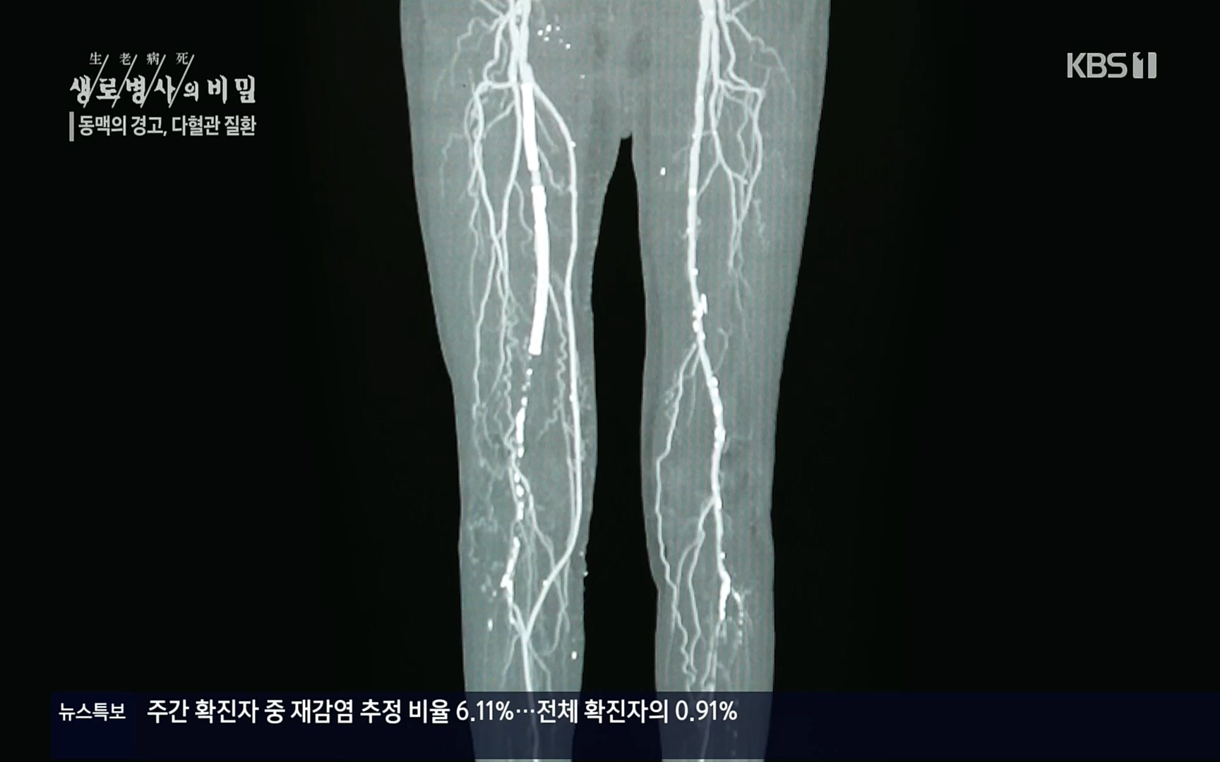 생로병사의 비밀.E831.220817p.H264-F1RST.mp4_20220822_185324.593.jpg