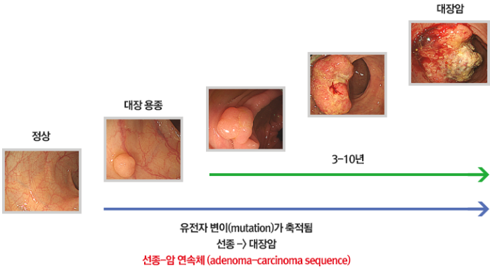 대장암