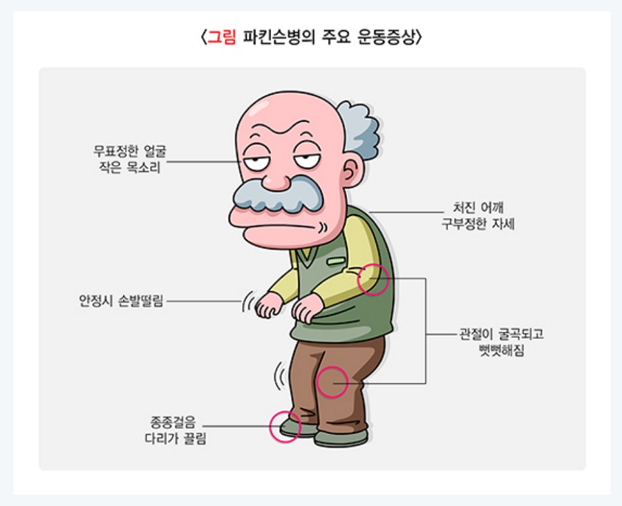 파킨슨병의 주요 운동증상