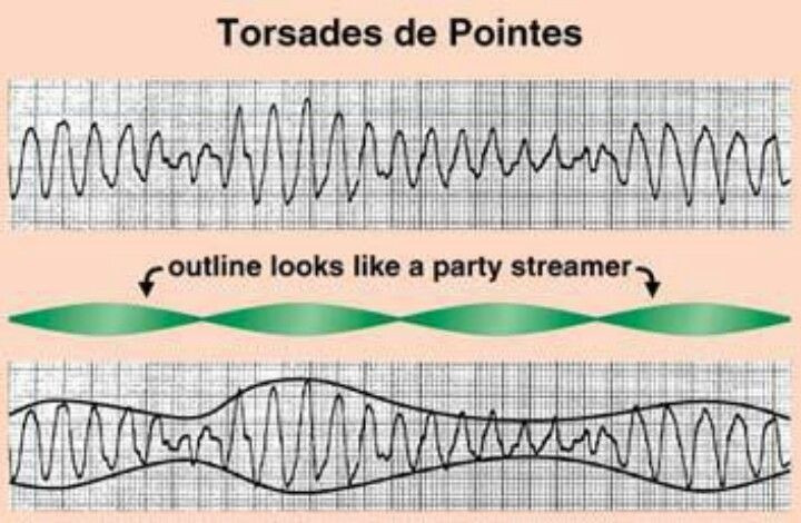 Torsade de Pointes 의 모양