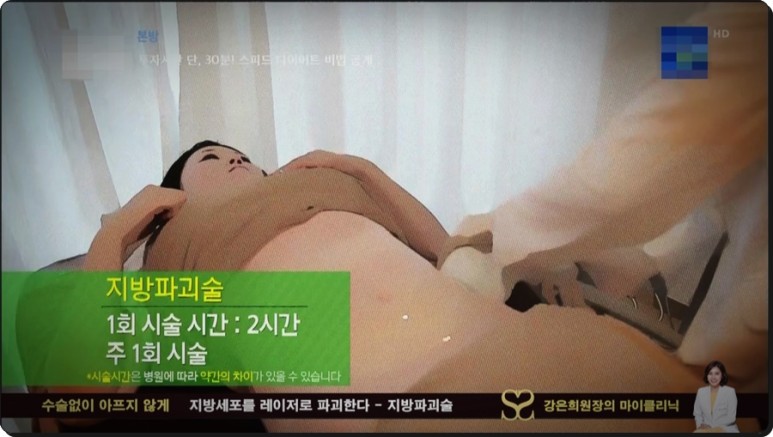 셀룰라이트 제거까지 지방파괴술 효과, 뱃살 다이어트부터 복부 18