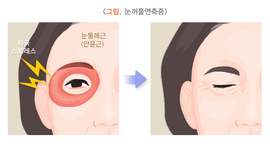  얼굴떨림(얼굴연축_눈꺼풀연축)