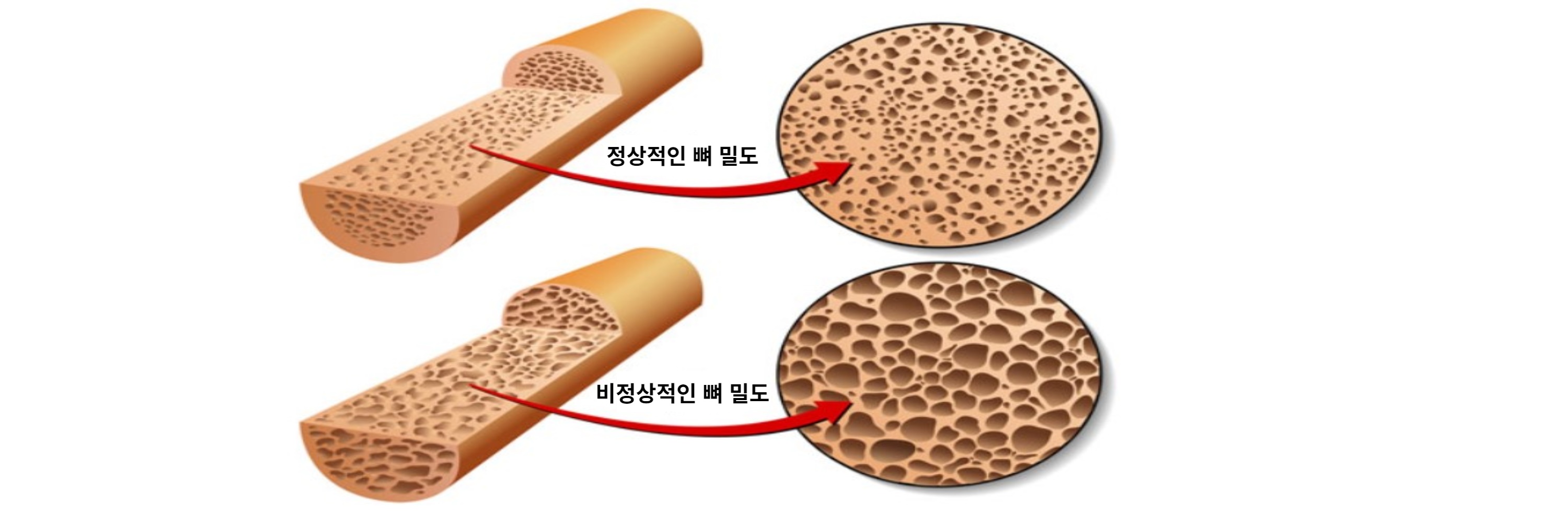 정상적인 골밀도와 비정상적인 골밀도의 차이점