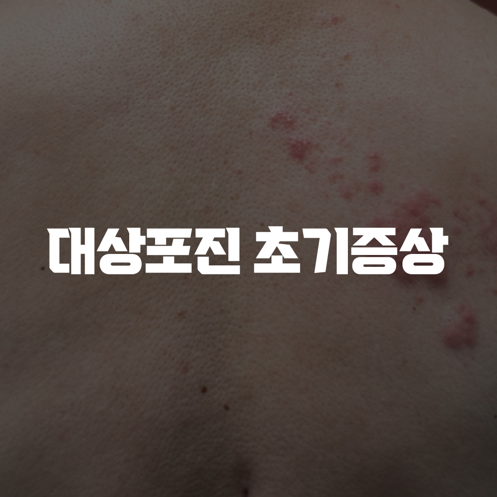 대상포진 초기증상