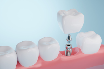 임플란트 치료 개요