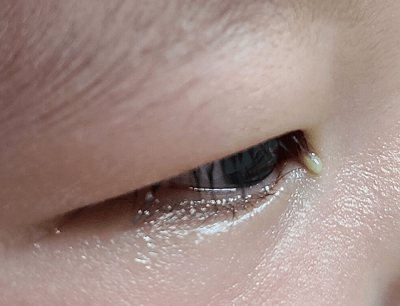 결막염 초기 증상 눈꼽