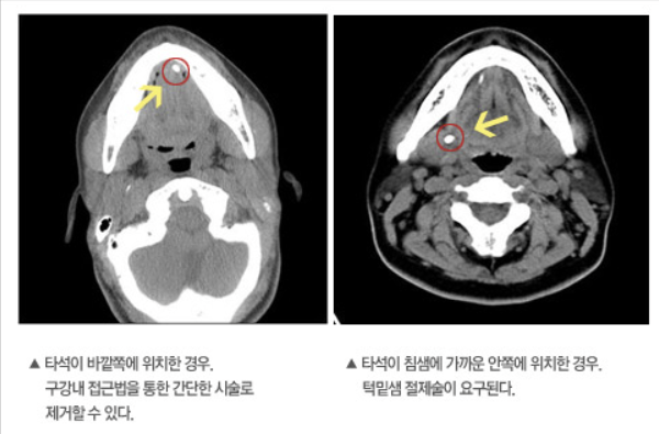  타석증 갑상선기능항진증