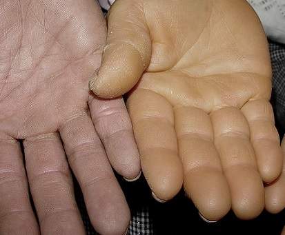 일반적인 손바닥(좌)과 카로틴혈증 손바닥(우)