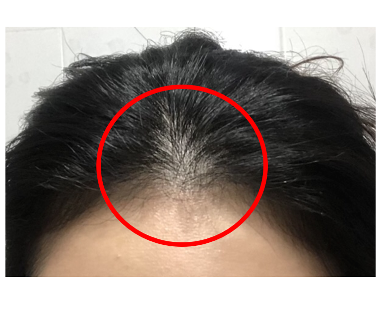 여자 앞머리 탈모가 빠지기 시작했나요? 7