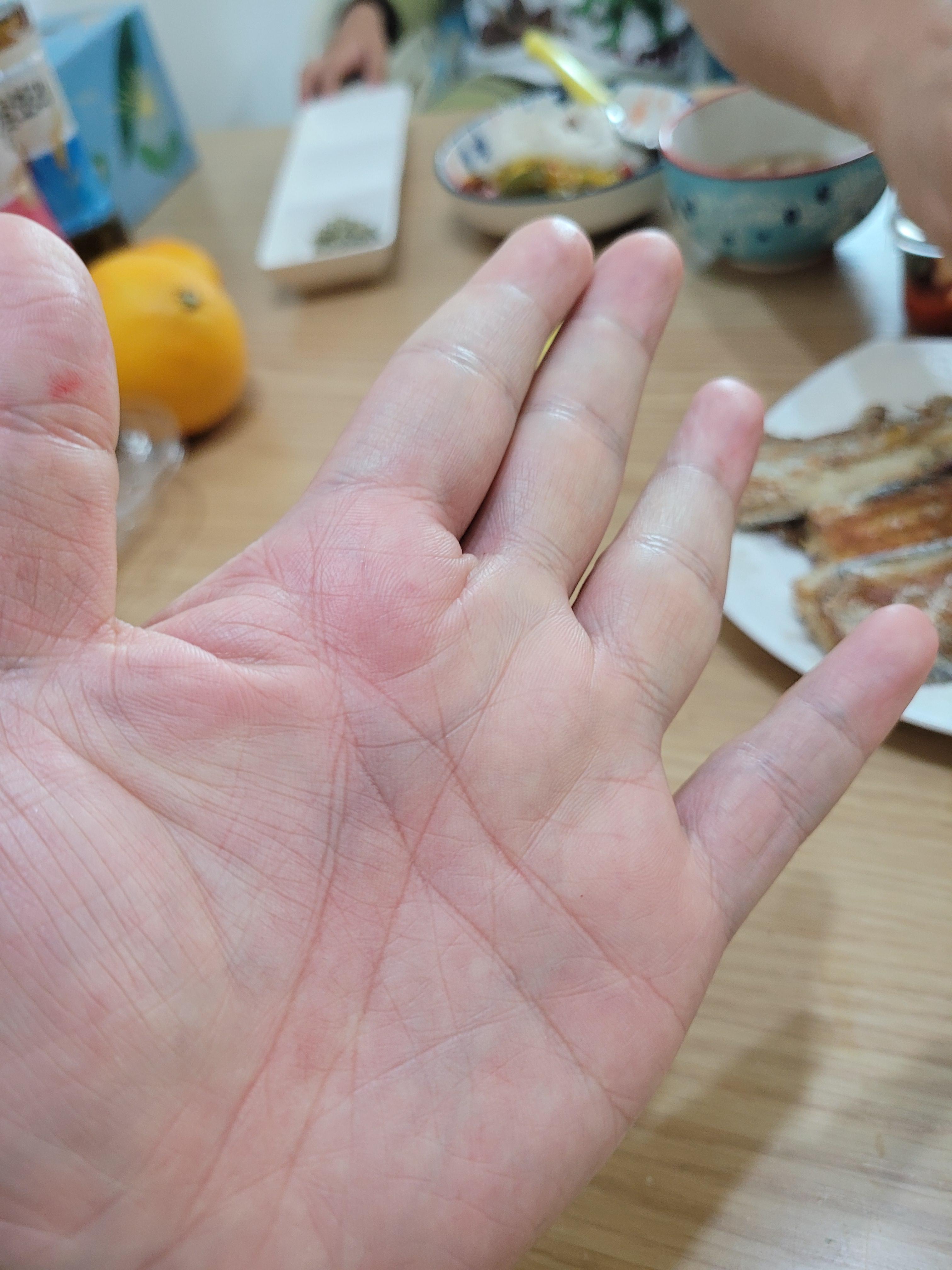  모더나 백신 2차 부작용