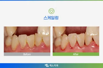 스케일링 후 양치 통증 음식_4