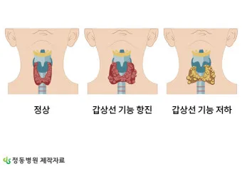 갑상샘 저하증 갑상선 기능저하증 증상 수치 치료_8