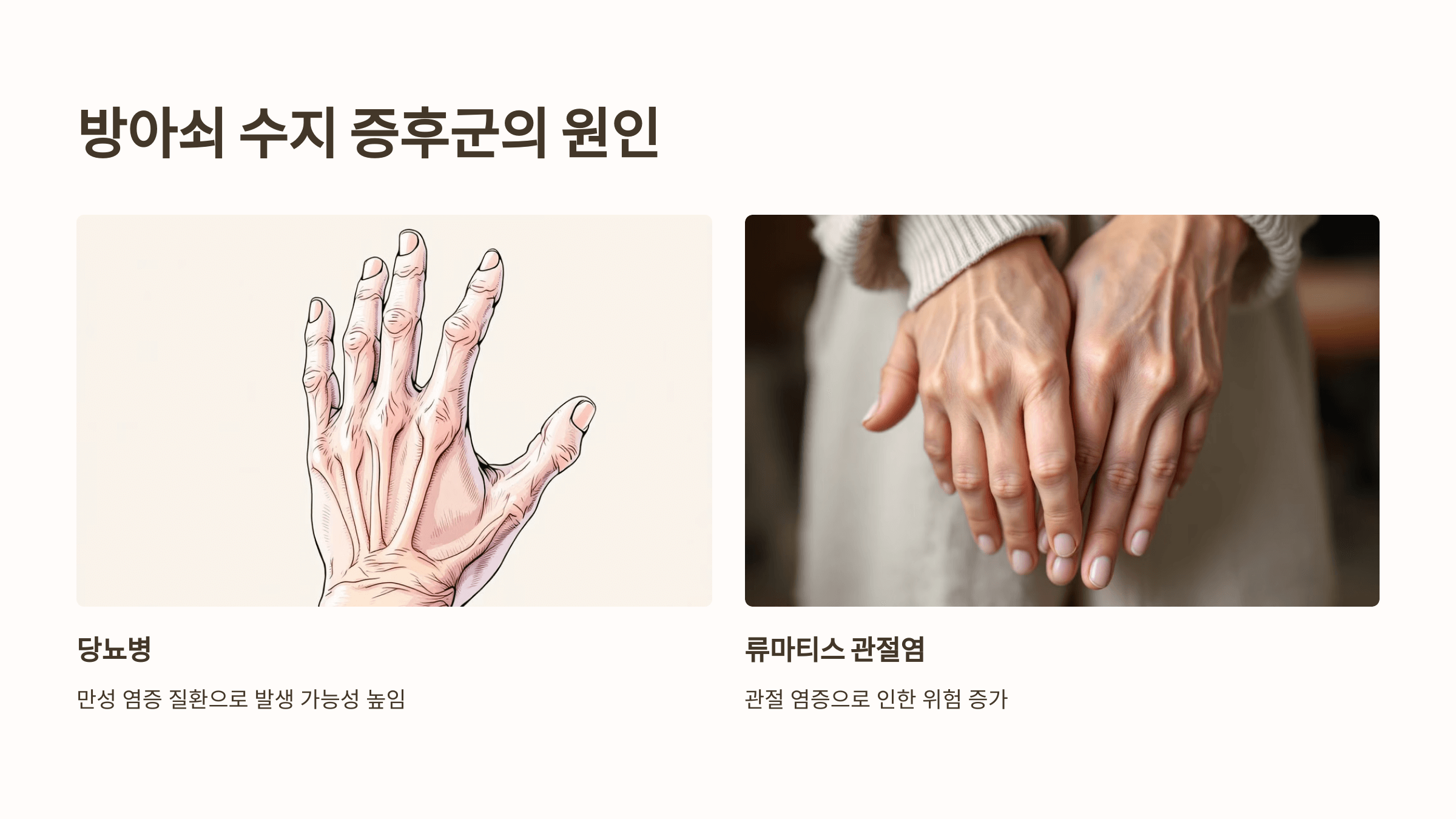 방아쇠 수지 증후군 관련된 사진입니다.