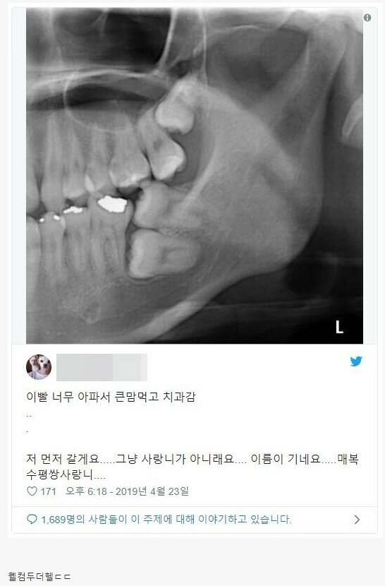  (치과) 매복수평쌍사랑니