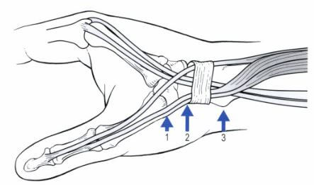 단무지신근과 장무지외전근의 힘줄에 문제가 생겨 통증이 잘 나타나는 부위 3군데 중수골&#44; 손목뼈&#44; 요골뼈 고랑을 표시해놓은 그림.